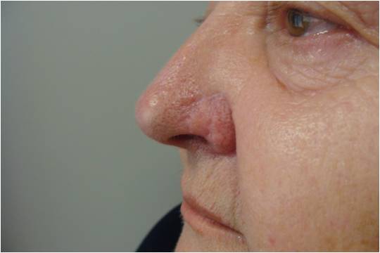 Reconstruction of the defect of the nose skin graft - after 6 months